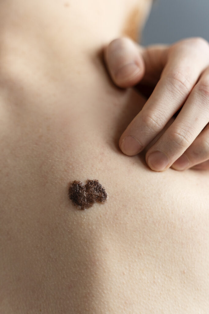 top 10 Wart Removal Cream india