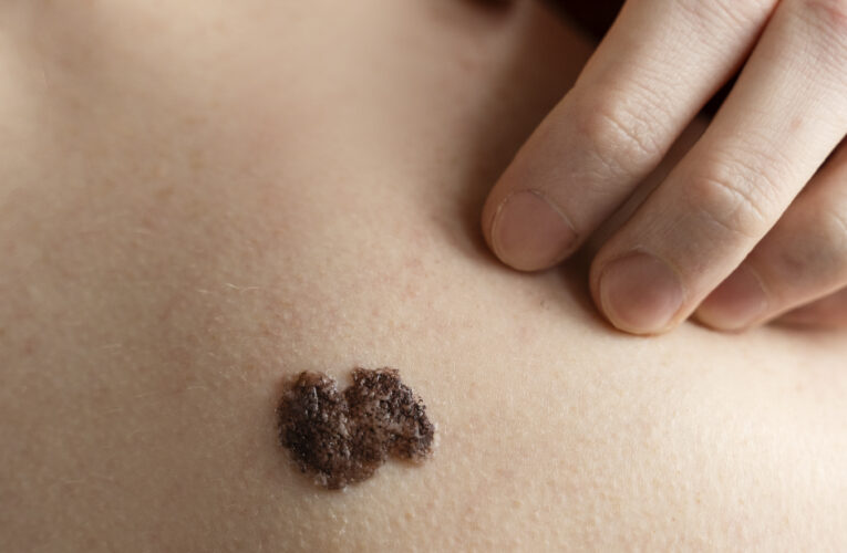 Top10 Best Eye Wart Removal Cream Starting 90 INR